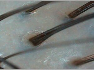 Diagnóstico capilar con microcámara: cuero cabelludo sano y limpio